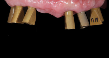 Dental implant abutment design is “a small stone in the whole mosaic”