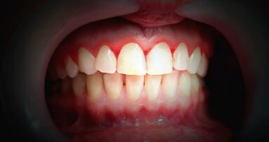 I přes dobrou ústní hygienu může lokální zánět dásní postihnout vzdálená zdravá místa v ústech