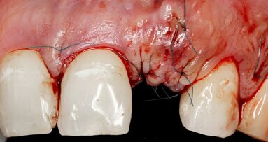 Pacijenti alergični na penicilin rizičniji za gubitak dentalnih implantata
