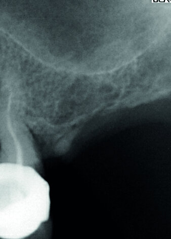 Après une séance d’ostéoactivation, pose à 45 jours d’un implant Fractal, le gain osseux obtenu à
l’apex de l’implant est bien visible à la radiographie de contrôle.