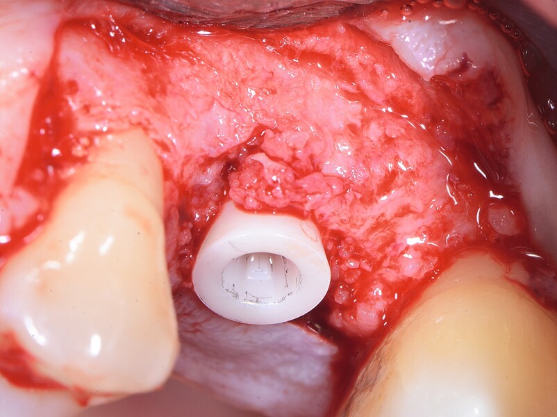 Fig. 8 : Fin du traitement chirurgical. Implant deux pièces en céramique au niveau tissulaire. 