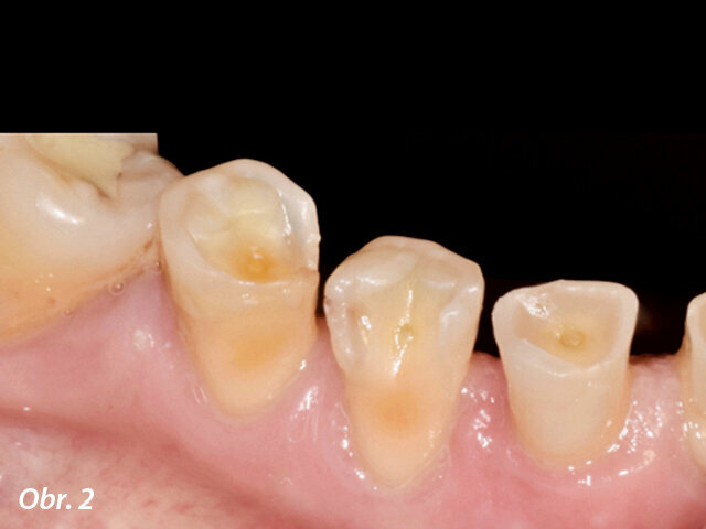 Obr. 2: Velké oblasti úbytku skloviny v krčkové části v důsledku silné abraze a eroze skloviny, jejímž výsledkem byla velmi bolestivá hypersenzitivita dentinu.