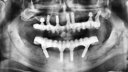 Kombinace standardních a ultrakrátkých implantátů při rehabilitaci celých úst