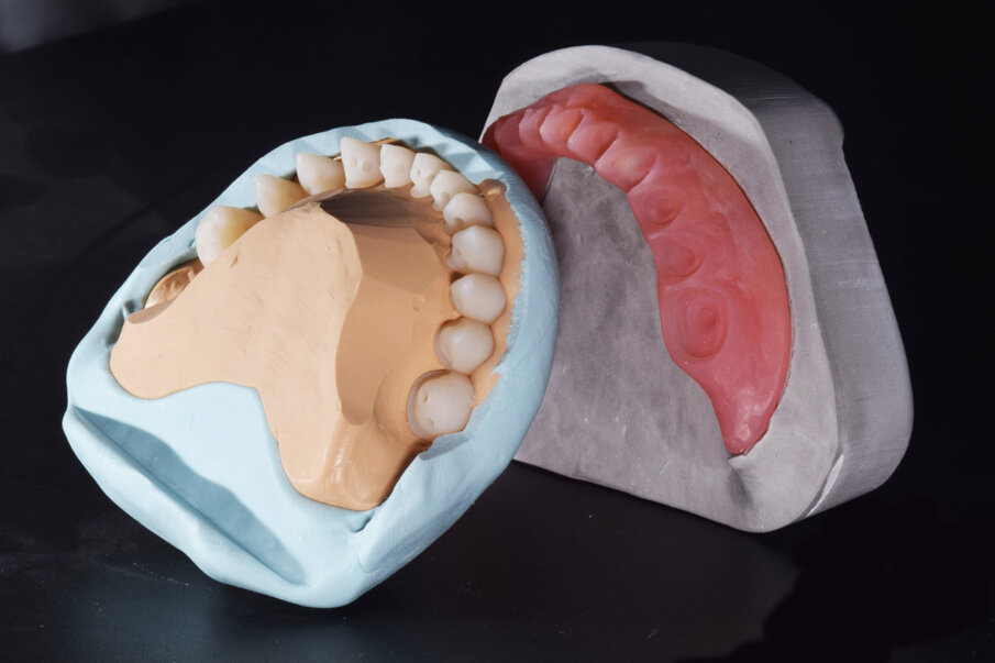 Fig. 17: Silicone wall for fixing the denture teeth in their defined positions in the mandibular denture base (CediTEC Adhesive).