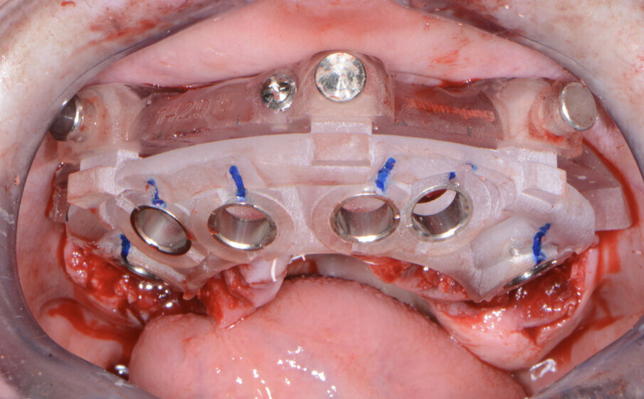 Fig. 9: Maxillary implant surgical guide.