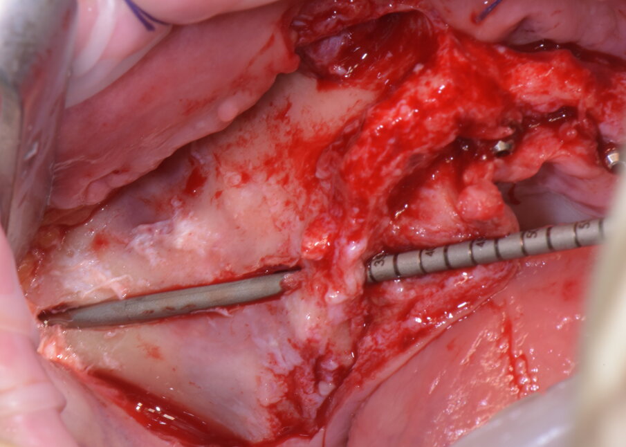 Figg. 24-26 - Inserimento implantare in emiarcata destra.