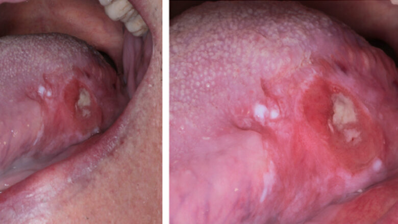 Fig. 5. Carcinoma de lengua. Clínicamente, el tumor puede ser indistinguible, pero existen datos que lo identifican claramente.