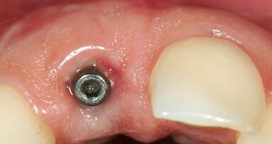 Replacement of a single anterior tooth: Surgical procedure and three-year results