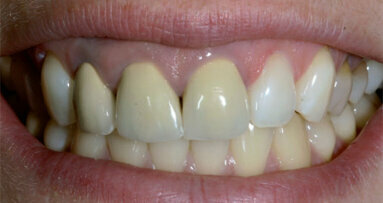 Aesthetics with all-ceramics and tooth whitening