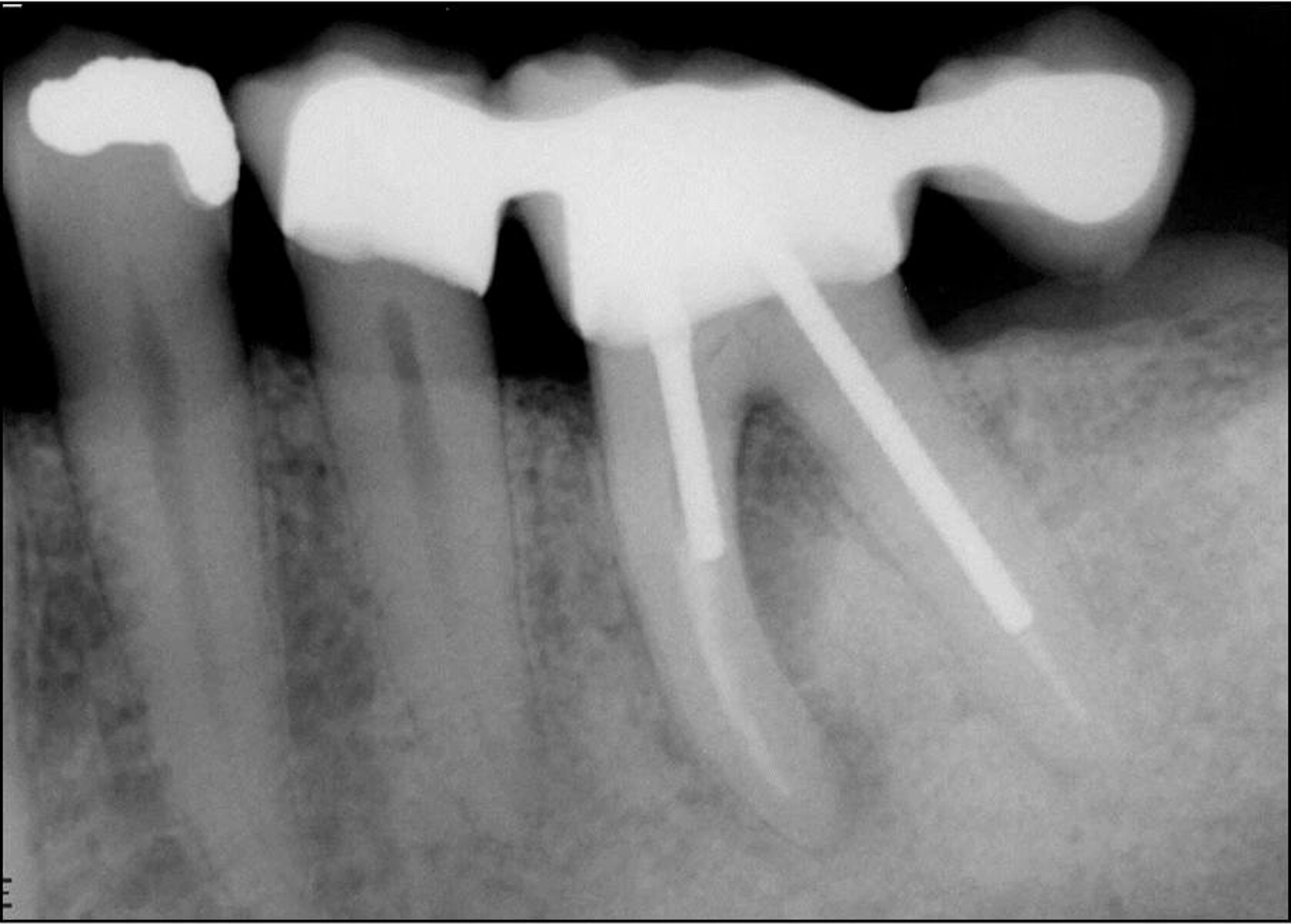 Buccal root of the bifurcated maxillary premolar—a danger zone during