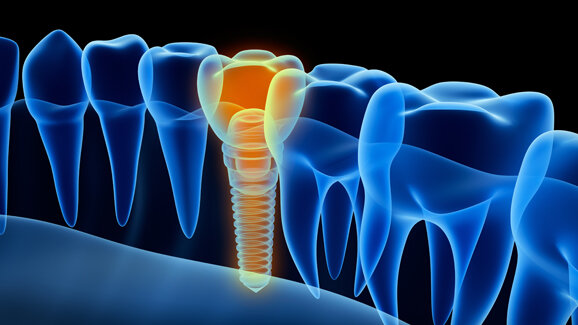 Ceramic implants: What benefits do they offer?