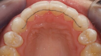 The Inman Aligner: Alignment, bleaching and bonding—A progressive approach to smile design (Part II)