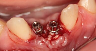 Leczenie implantoprotetyczne w przebiegu dysplazji ektodermalnej – 5-letnie obserwacje