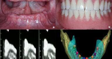 Principios de la planificación digital en implantología oral