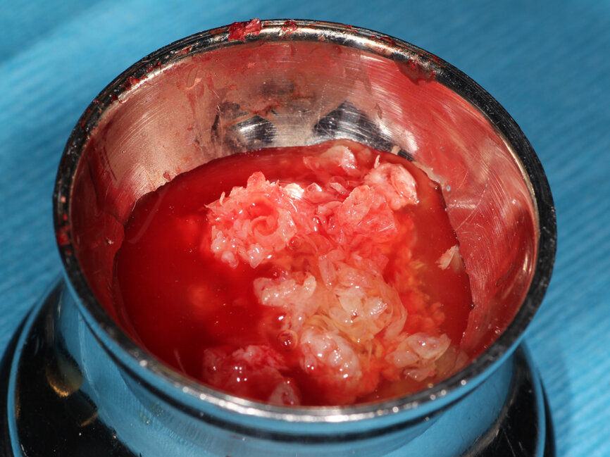 Fig. 8: Buffy coat from the PRP tubes that had been centrifuged is added to the sterile dish containing the harvested autogenous bone and particulate graft material. 
