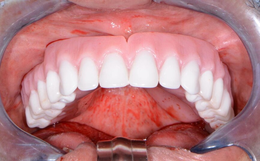 Fig. 8: Try-in of immediate denture.