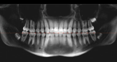 Comparison of tooth mesiodistal angulation measurements