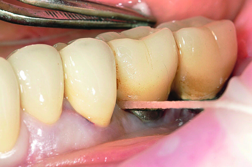 Fig. 8 : Après le scellement
de la prothèse, élimination minutieuse de l‘excès de ciment au moyen d‘un fil dentaire.