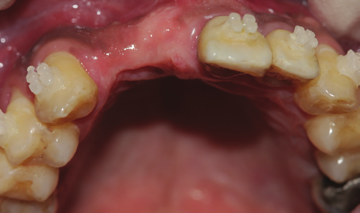 Figure 10: Intraoral view showing teeth loss on sites no 7 and 8 after restoring the space orthodontically.