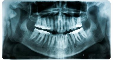 Analyse van tandheelkundige röntgenfoto’s door AI bespaart tijd in patiëntenzorg