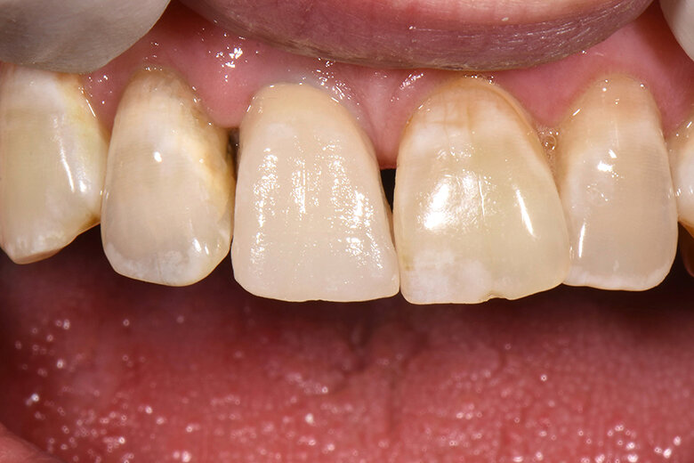 Fig. 3. Resultado tras la primera cocción de dentina durante la prueba clínica en boca.