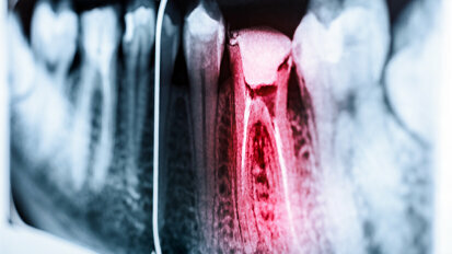 Istraživači planiraju da razviju senzor za pametni telefon kako bi otkrili bol u zubima