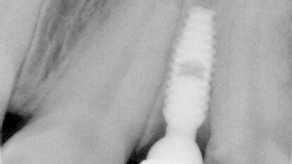 Aproximální rozšíření mezi kořeny zubů za účelem zavedení úzkého implantátu