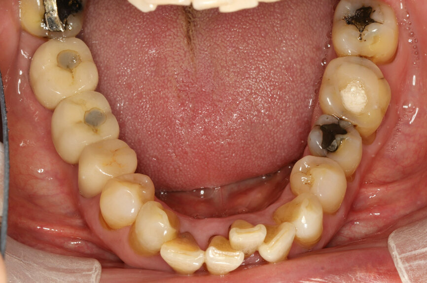 Fig. 1: Intra-oral occlusal view.