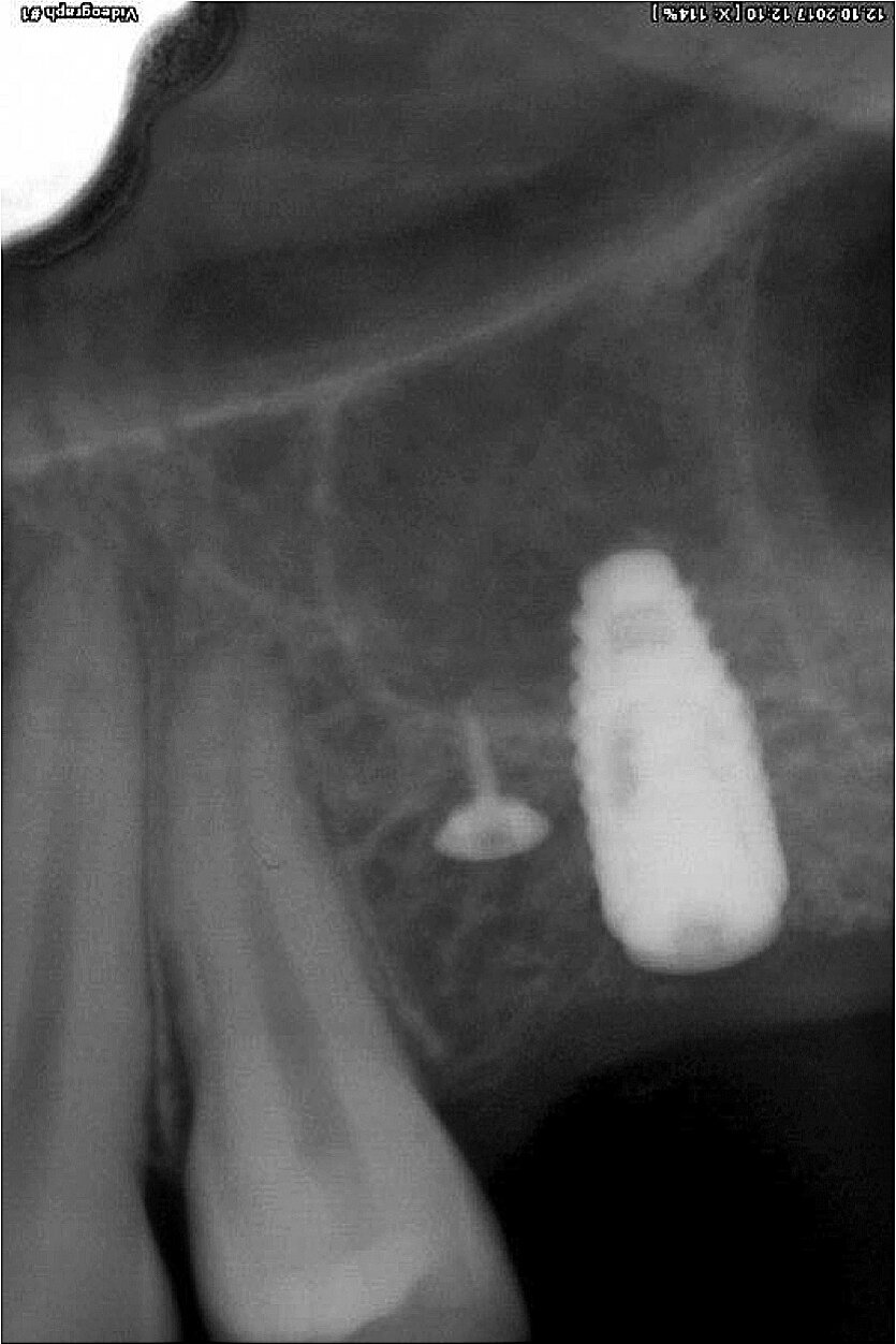 Implantology of Fractures of the Clavicle