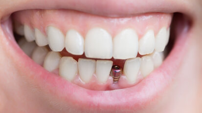 EFP publishes guideline on prevention and treatment of peri-implant diseases