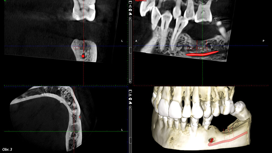 CBCT sken po 3 měsících od odstranění implantátu.