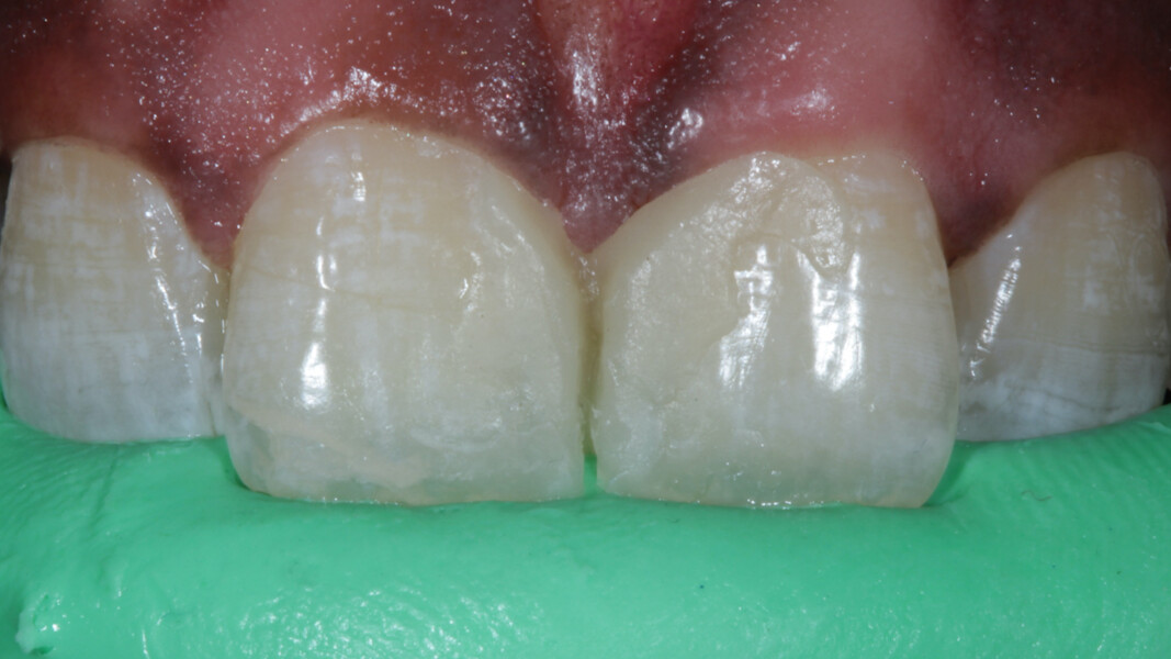 Fig 6. Once verified, a putty index was made with A-Silicon to record the palatal surface.