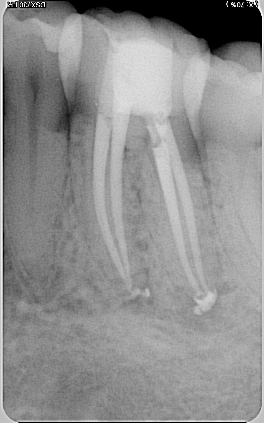 Fig. 6: Post-op radiographic images. (Image: © Dr Silviu Bondari)