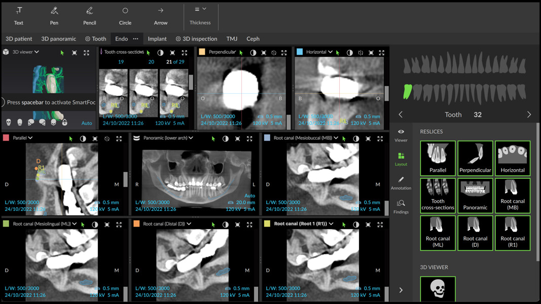 Fig. 14: Endodontic mode of DTX Studio Clinic showing different sections of the area and the relation between the mandibular canal, traced by the software, and the roots of the molar.