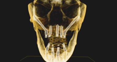 Implantes zigomáticos en la práctica común de la odontología