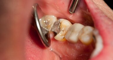 Dental filling failure linked to smoking, drinking and genetics
