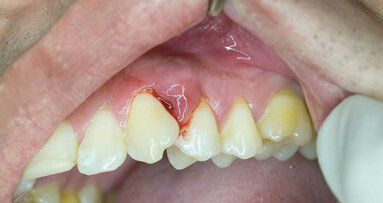Pesquisadores desenvolvem tira e gel biodegradáveis para evitar perda óssea na periodontite