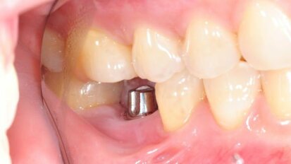 מעל 60 אחוז מבין רופאי שיניים כלליים מבצעים שתלים דנטליים