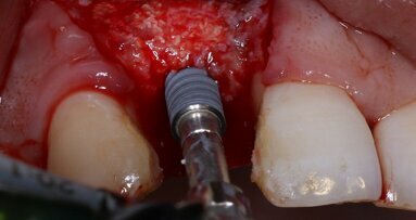 Revenue of global dental implant market expected to further increase