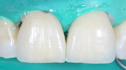 Clinical case: Central incisor veneers with PANAVIA V5
