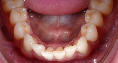 Accelerated aligners with photobiomodulation