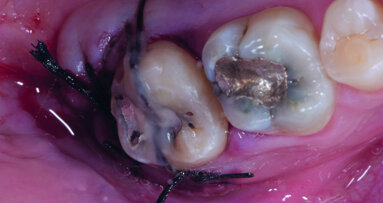 How to give a second life to third molars: A case series with follow-up