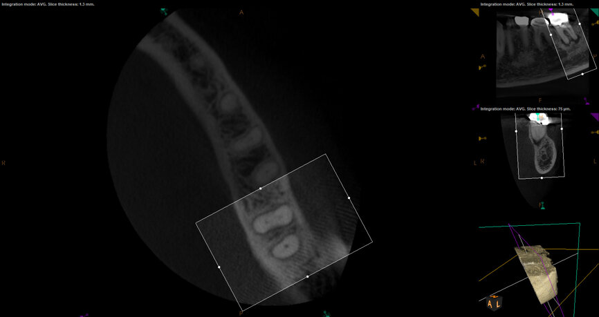 Fig. 17c: Case assisted with CBCT to determine anatomy pre-operatively. Note the multiple cross sections moving apically and the correlation to the 2-D view. Note also the conservative taper in relation to the root width. (Courtesy of Dr. Brett Gilbert)