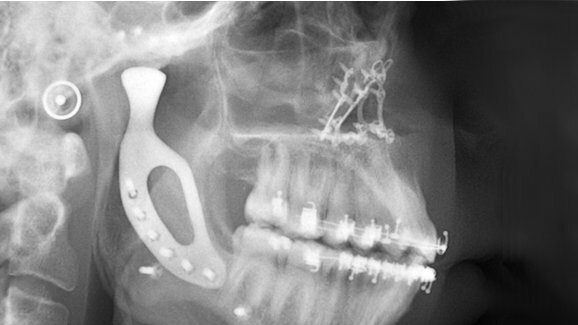 Chirurgen plaatsen 3D-geprint titanium kaakgewricht
