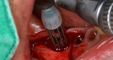 Novel surgical procedure may help combat peri-implantitis