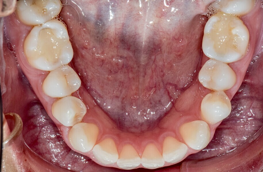 Fig. 9: A mandibular left premolar exhibiting a 76° rotation according to Invisalign’s ClinCheck software.