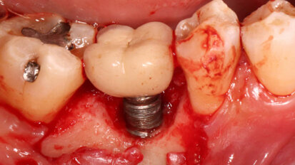 Estudo determina os motivos das técnicas de remoção e falha de implantes dentários