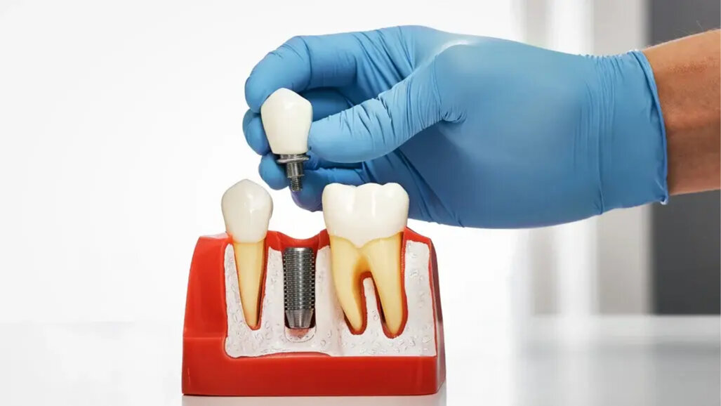 China limita custo de tratamento com implantes dentários