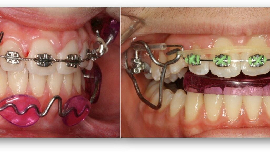 ¿Debe la industria dental determinar el futuro de la Ortodoncia?