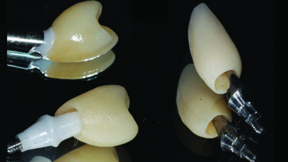 Funkcionalno estetska rehabilitacija  ortodontske anomalije minimalno invazivnim postupkom - timski pristup